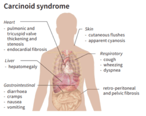 Carcinoid Heart Disease 1 image2 400x319 1